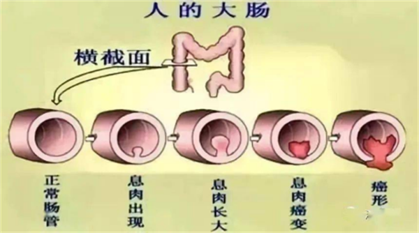 体检，你查胃肠镜了吗？812.png