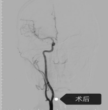 微创介入破“狭窄”，锦旗双至映仁心496.png